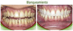 Blanqueamiento 01